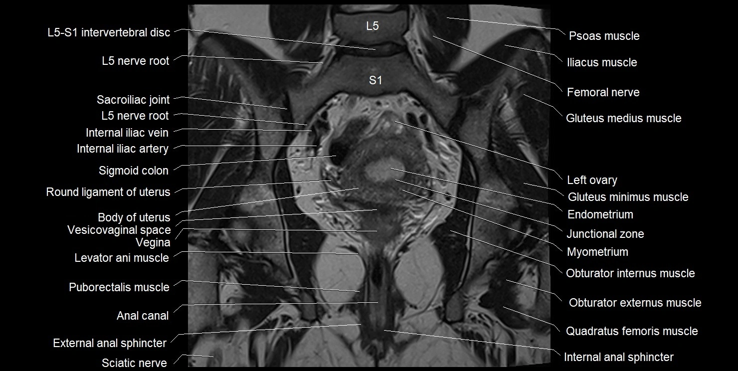 female pelvis coronal cross sectional anatomy image 21.webp